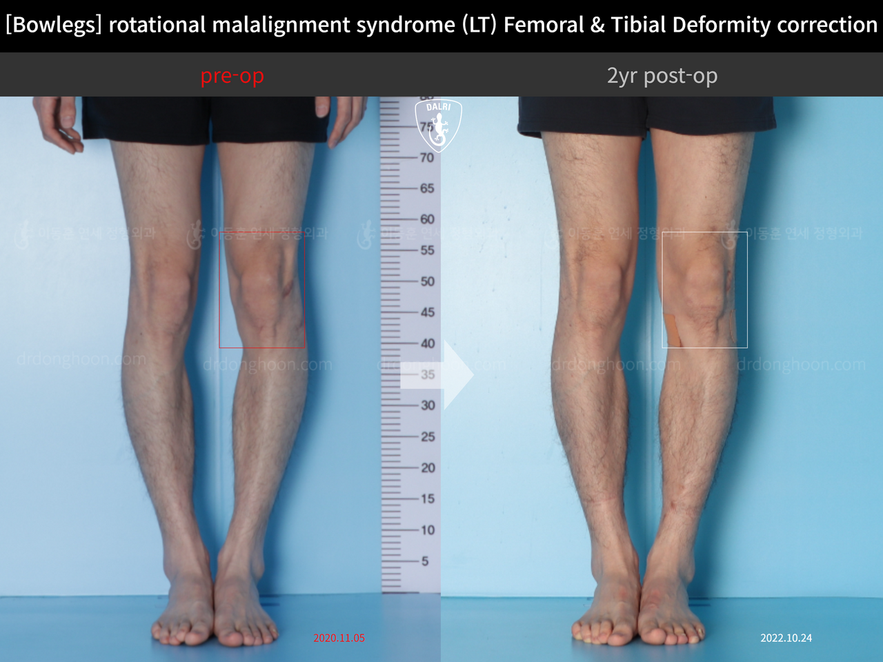 Before and after adult bowlegs, case 13266718, image 6, Dr. Donghoon institute (DALRI)
