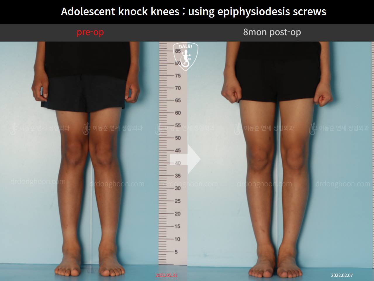 Before and after paediatric & adolescent knock knees, case 10171145, image 3, Dr. Donghoon institute (DALRI)
