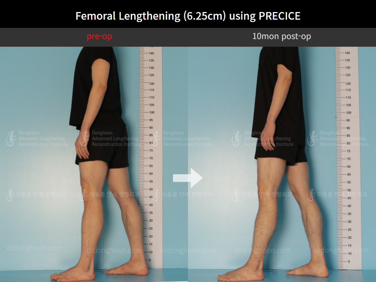 Before and after cll precice, case 8759307, image 4, Dr. Donghoon institute (DALRI)