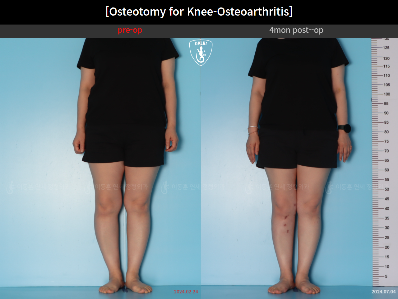 Before and after osteotomy for knee osteoarthritis, case 39778471, image 2, Dr. Donghoon institute (DALRI)