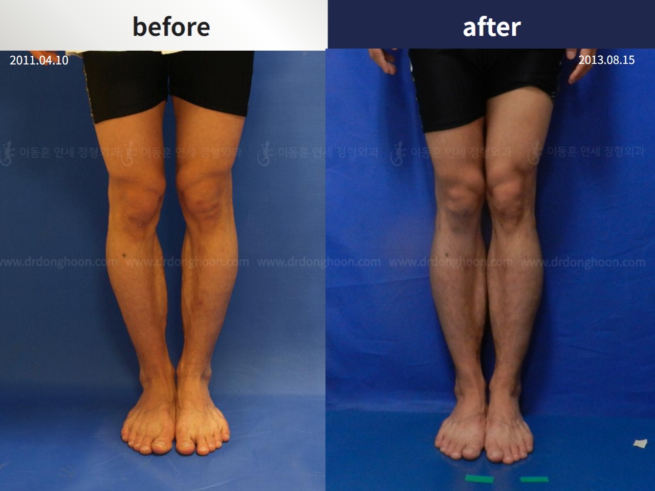Before and after cll + deformity correction, case 4323126, image 1, Dr. Donghoon institute (DALRI)