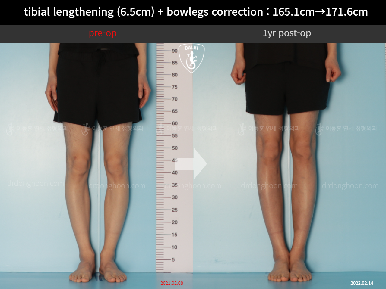 Before and after cll + deformity correction, case 10379185, image 5, Dr. Donghoon institute (DALRI)