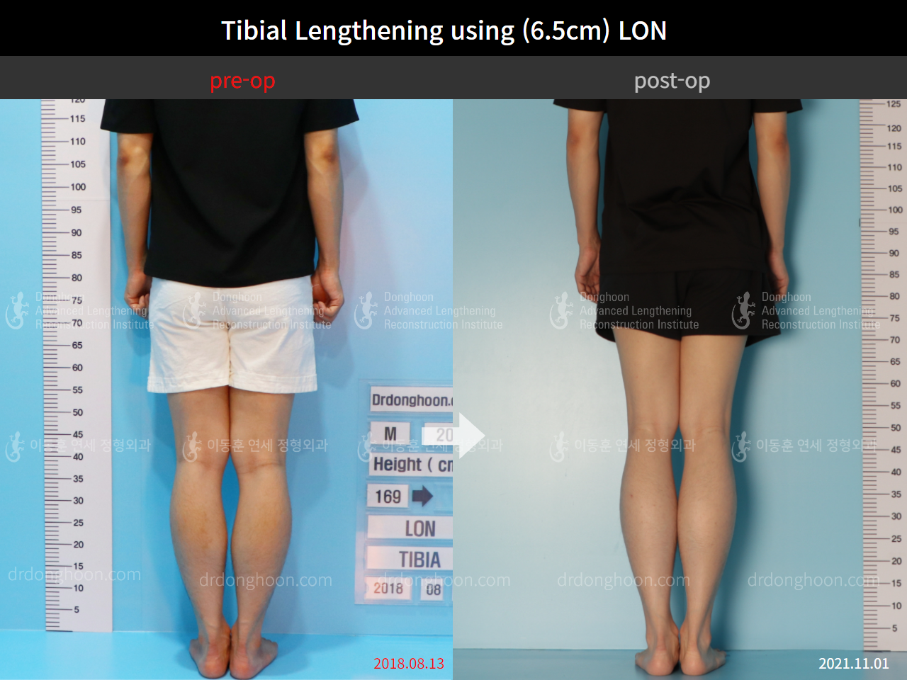 Before and after cll lon, case 8777040, image 6, Dr. Donghoon institute (DALRI)