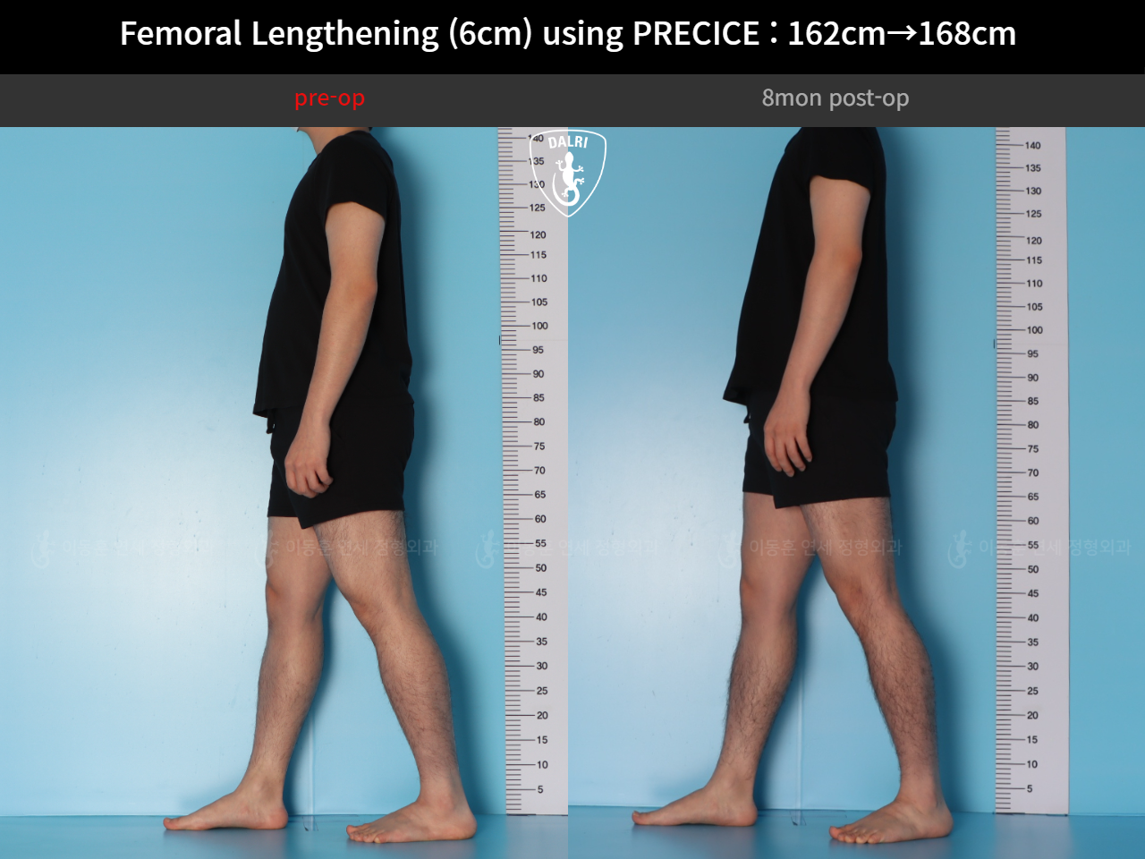 Before and after cll precice, case 52565195, image 4, Dr. Donghoon institute (DALRI)