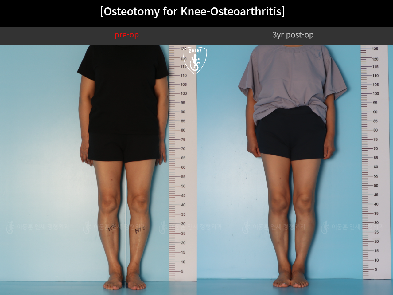 Before and after osteotomy for knee osteoarthritis, case 85842641, image 3, Dr. Donghoon institute (DALRI)