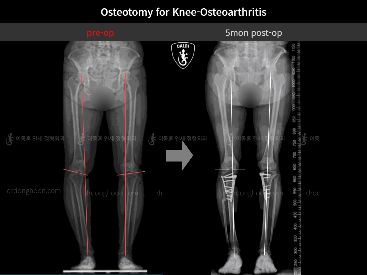 Before and after osteotomy for knee osteoarthritis, case 11047064, image 8, Dr. Donghoon institute (DALRI)