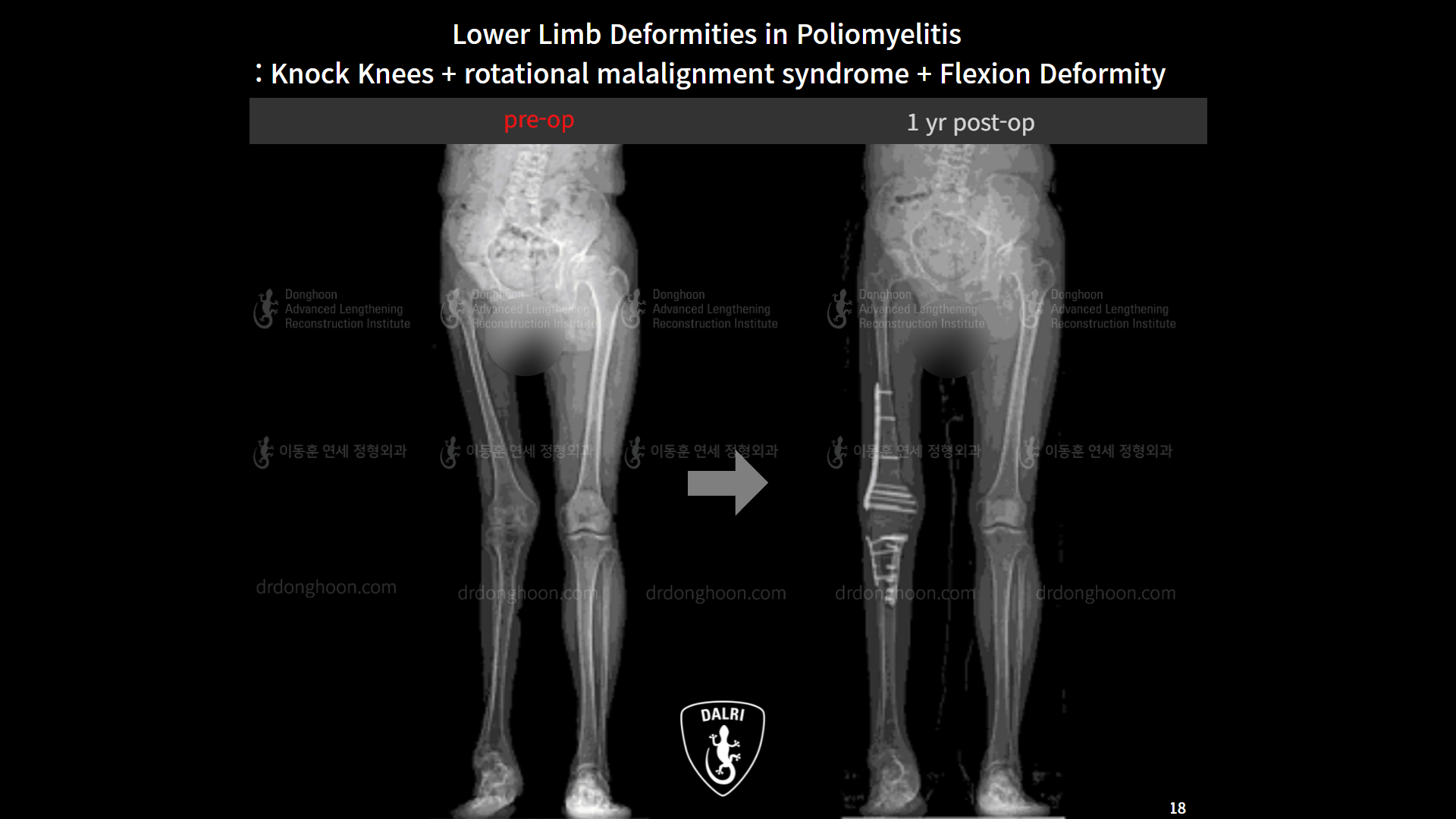 Before and after adult knock knees, case 9154930, image 5, Dr. Donghoon institute (DALRI)