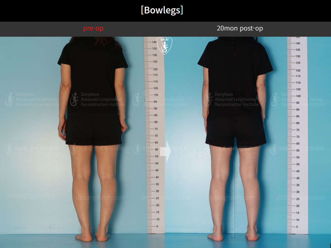 Before and after adult bowlegs, case 16724630, image 4, Dr. Donghoon institute (DALRI)