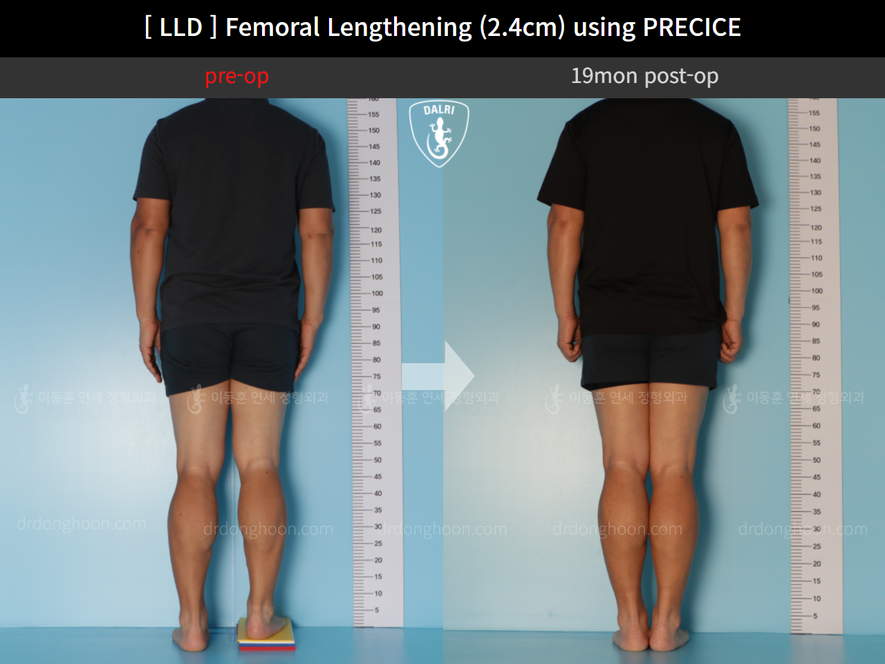 Before and after adult lld, case 10990486, image 2, Dr. Donghoon institute (DALRI)