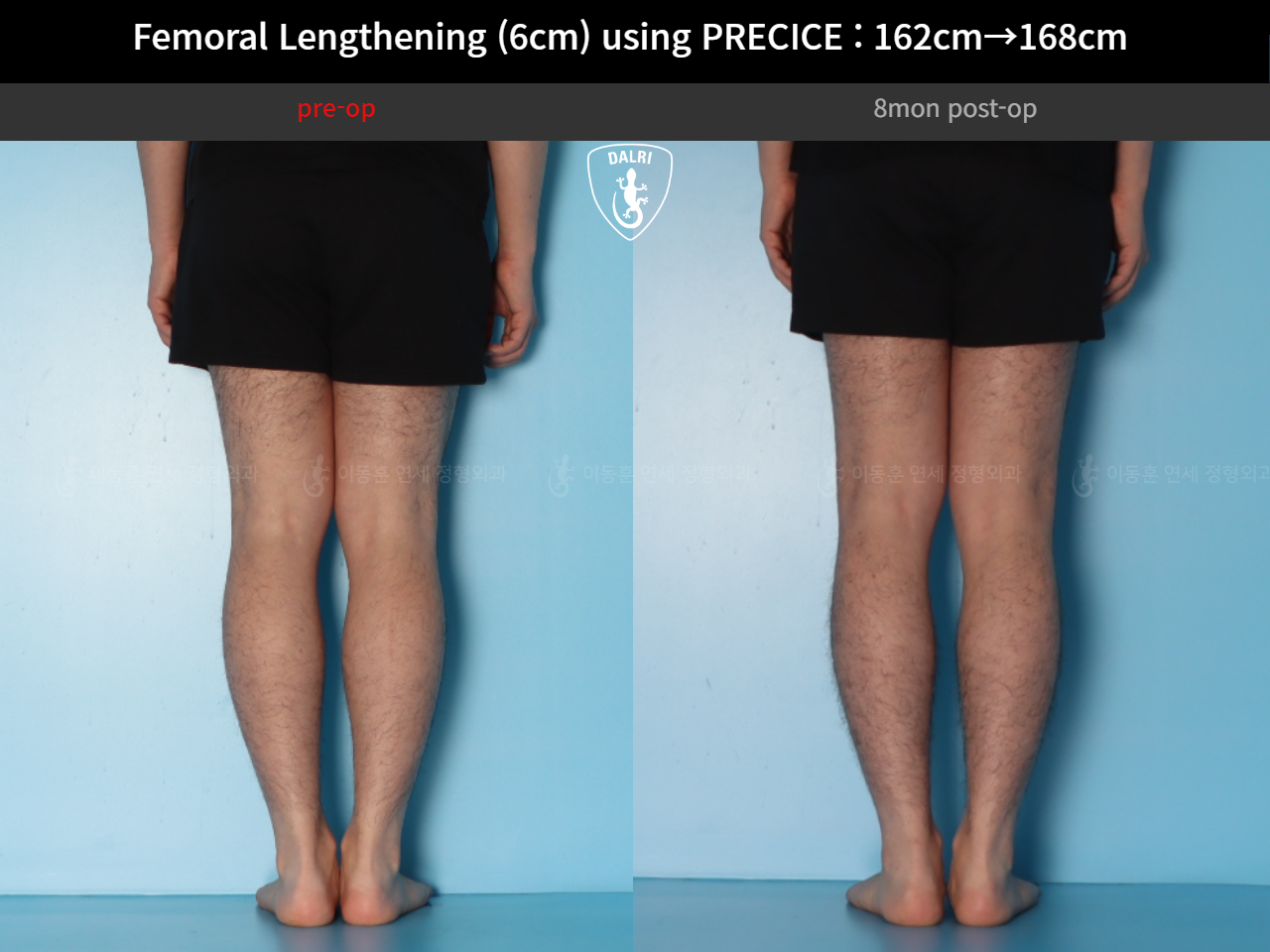 Before and after cll precice, case 52565195, image 8, Dr. Donghoon institute (DALRI)