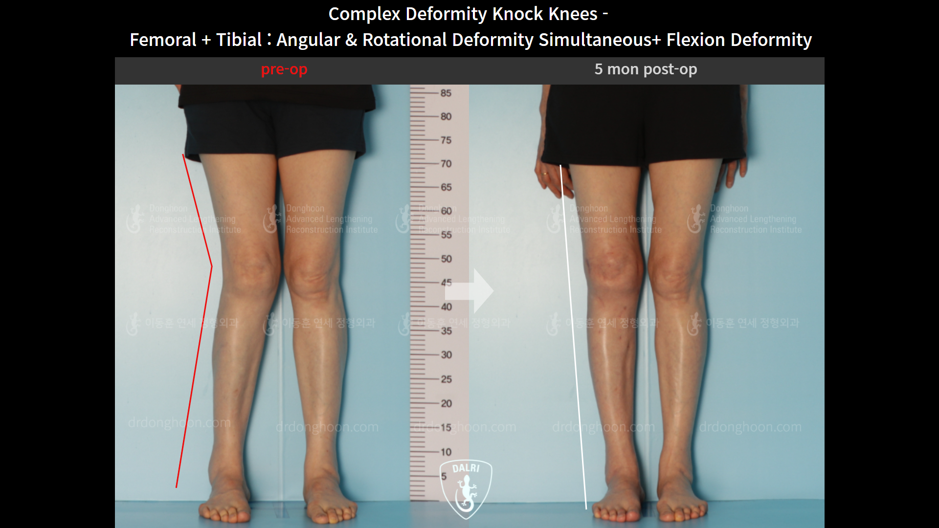 Before and after adult knock knees, case 9153798, image 4, Dr. Donghoon institute (DALRI)
