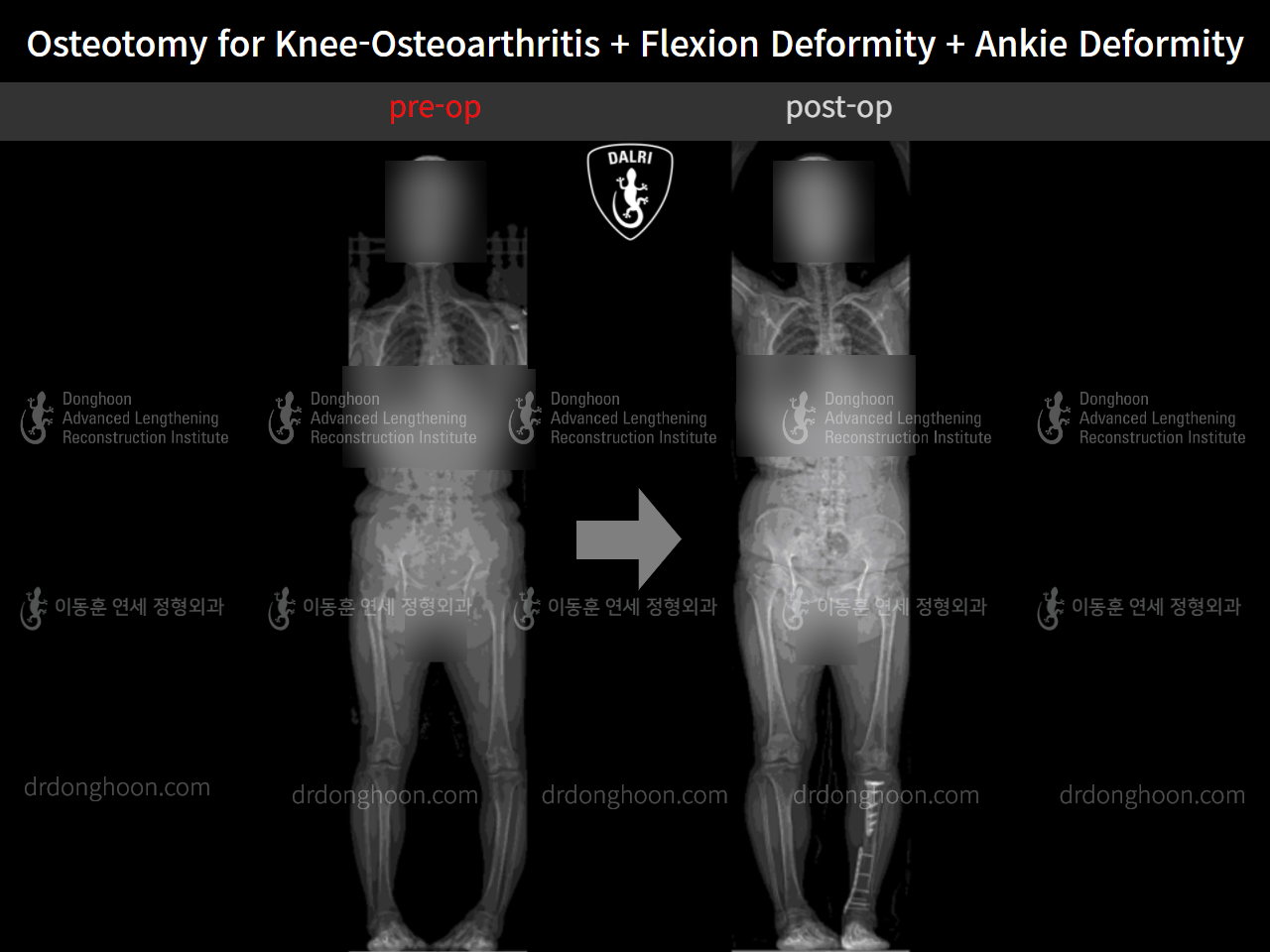Before and after osteotomy for knee osteoarthritis, case 5315780, image 1, Dr. Donghoon institute (DALRI)