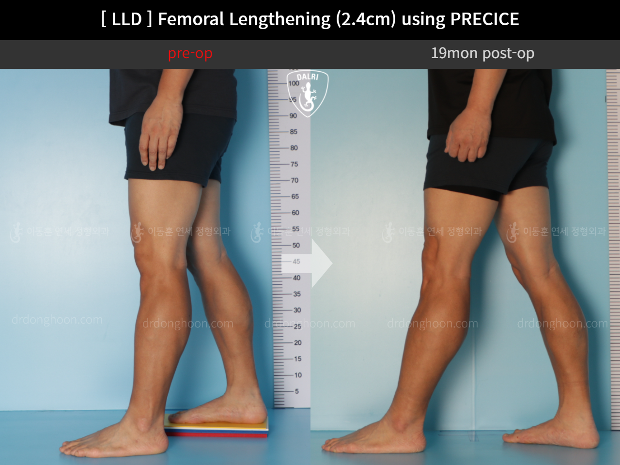 Before and after adult lld, case 10990486, image 8, Dr. Donghoon institute (DALRI)