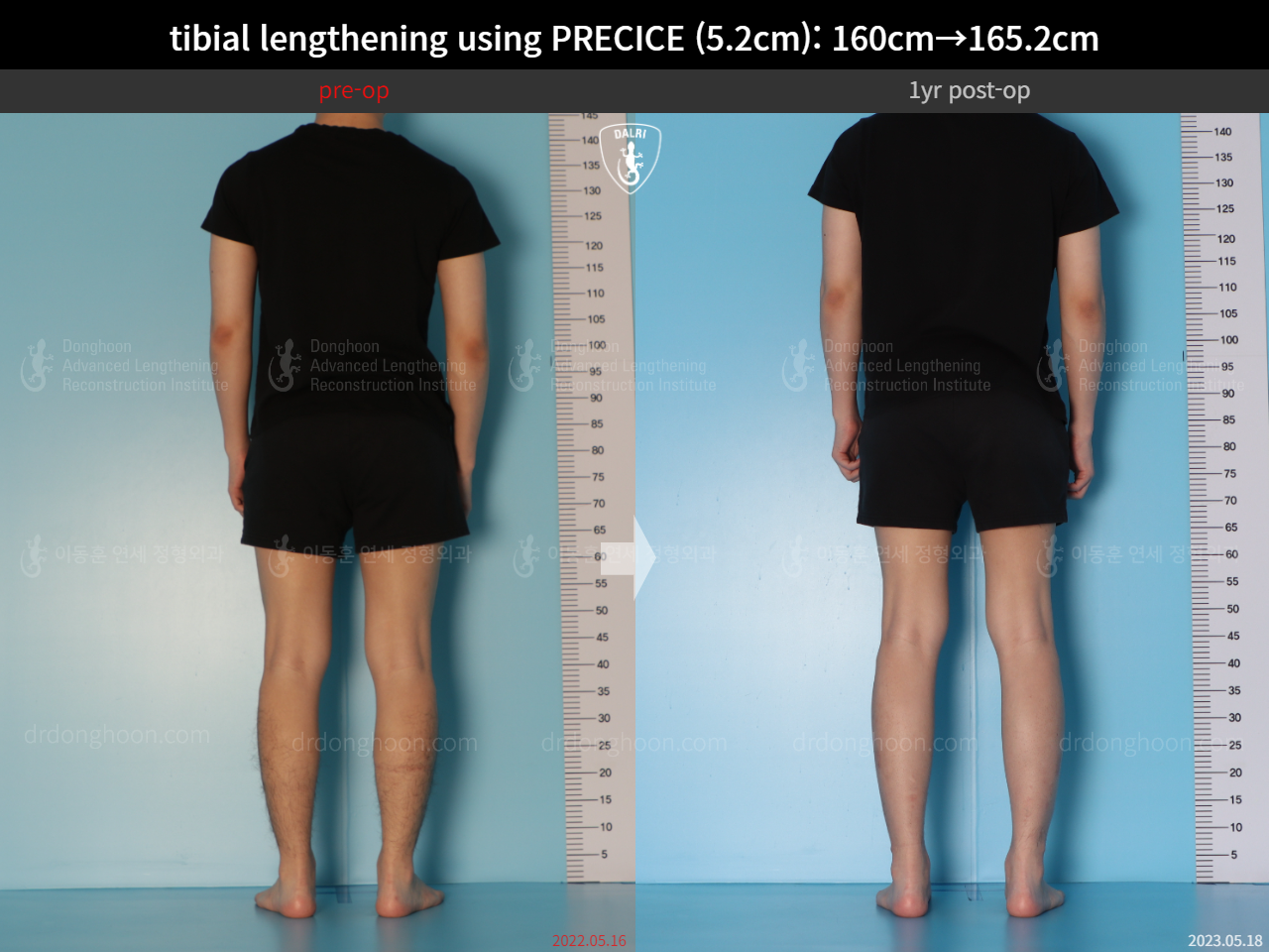 Before and after cll precice, case 15213098, image 4, Dr. Donghoon institute (DALRI)