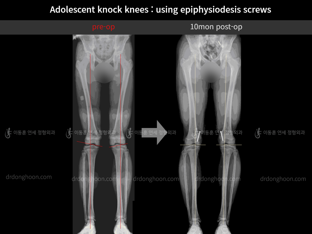 Before and after paediatric & adolescent knock knees, case 11511975, image 7, Dr. Donghoon institute (DALRI)