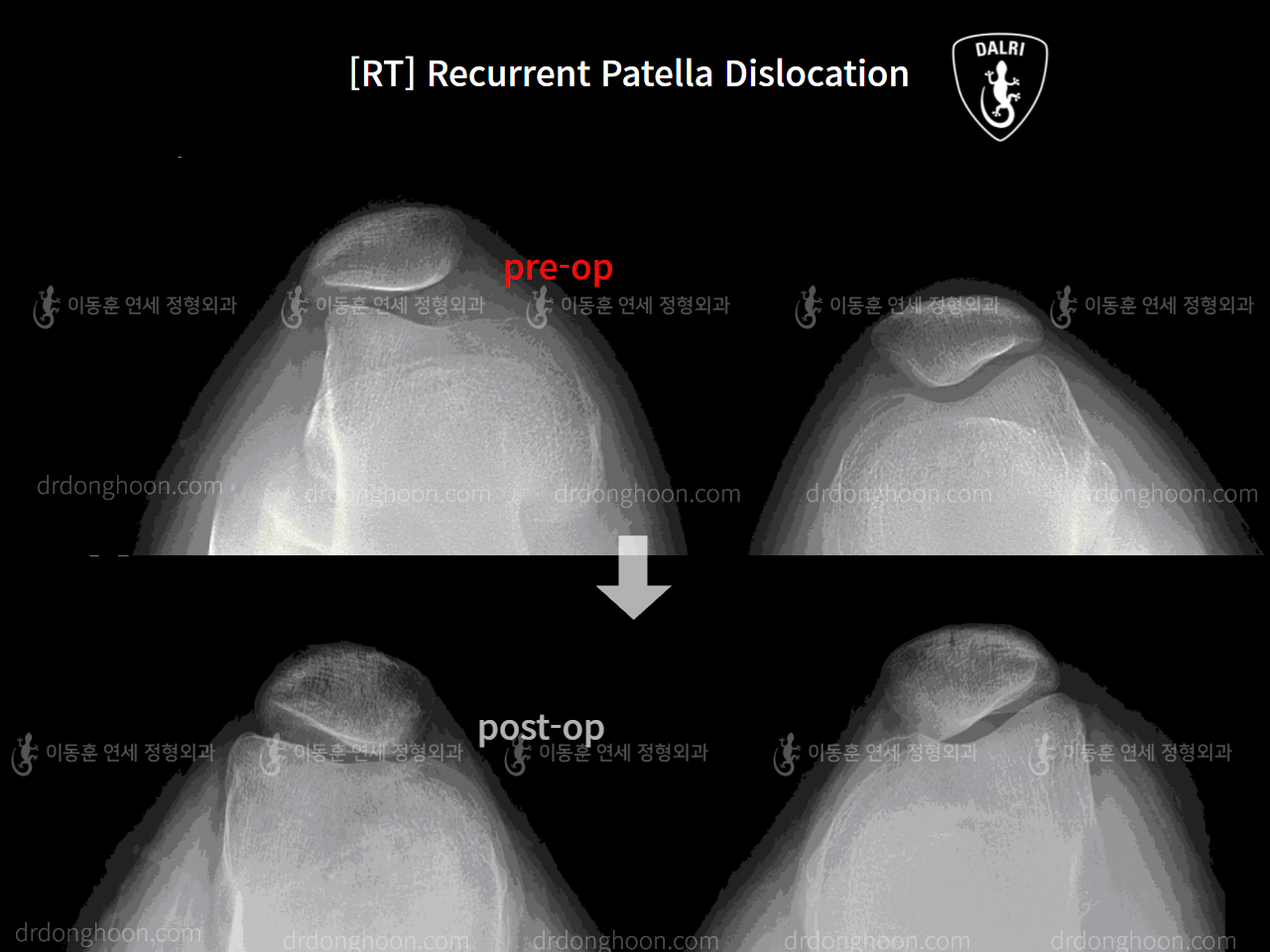 Before and after recurrent patella dislocation, case 9159663, image 1, Dr. Donghoon institute (DALRI)