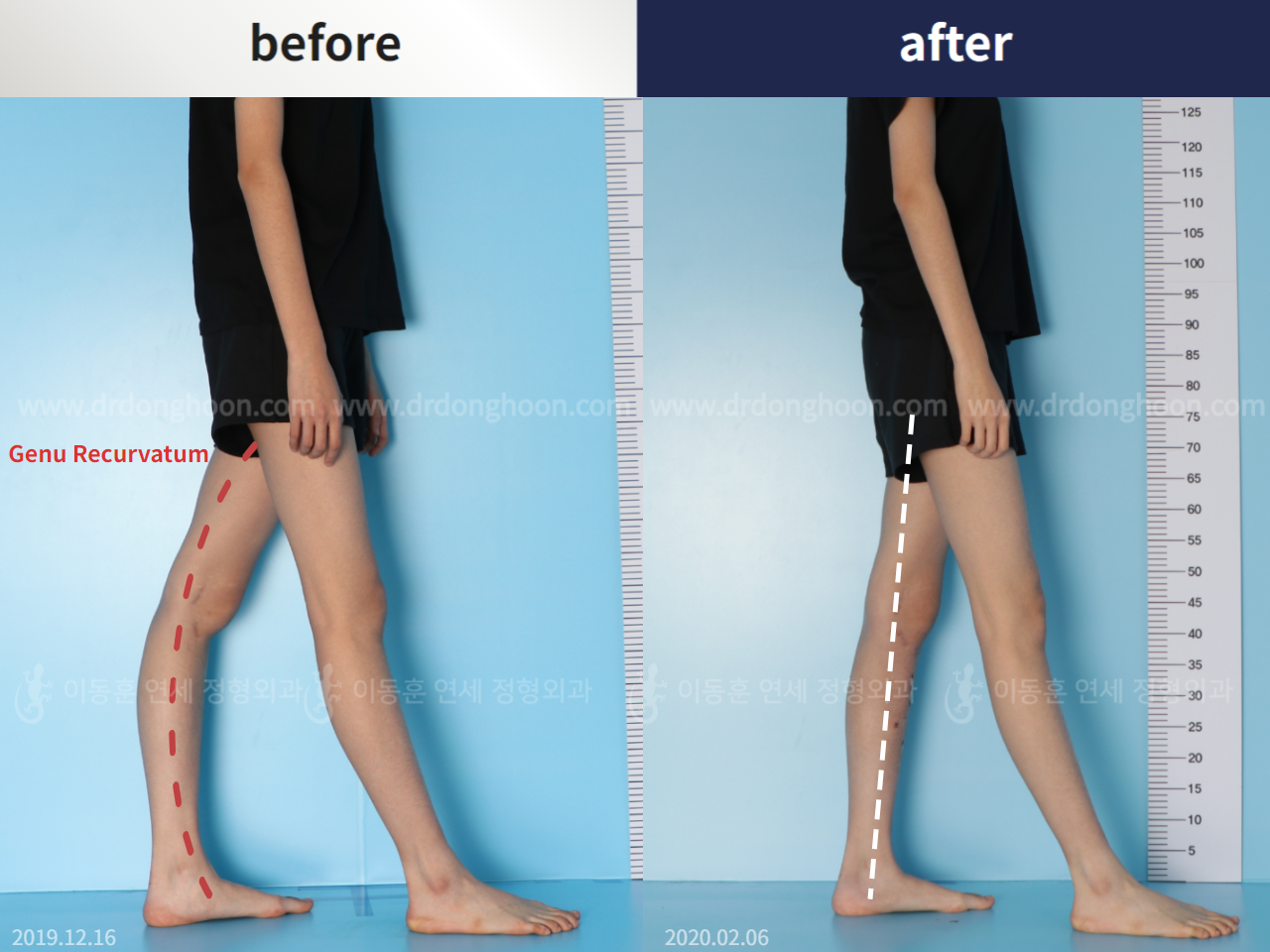 Before and after genu recurvatum, case 5346189, image 2, Dr. Donghoon institute (DALRI)