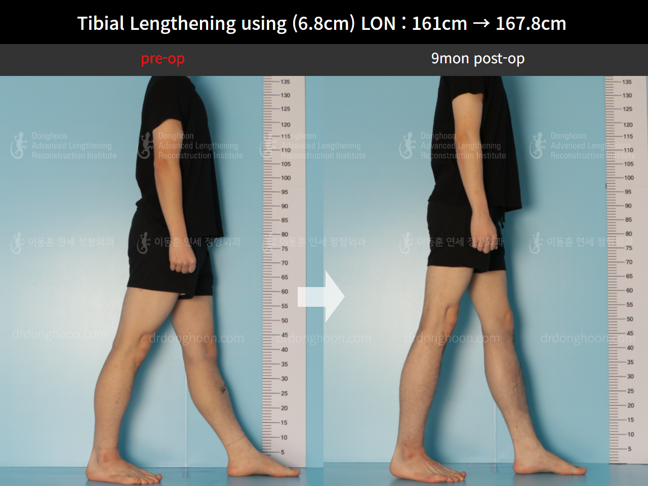 Before and after cll lon, case 8663720, image 4, Dr. Donghoon institute (DALRI)