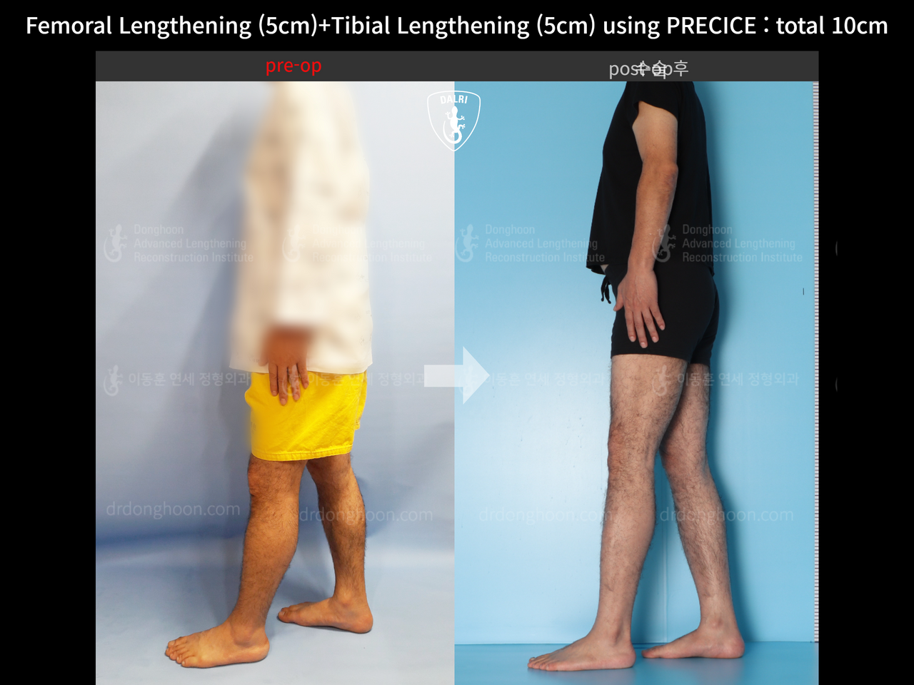 Before and after cll precice, case 13390688, image 3, Dr. Donghoon institute (DALRI)