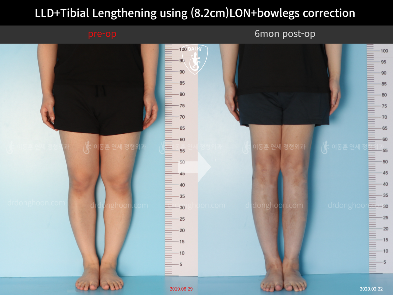 Before and after cll + deformity correction, case 12782230, image 3, Dr. Donghoon institute (DALRI)