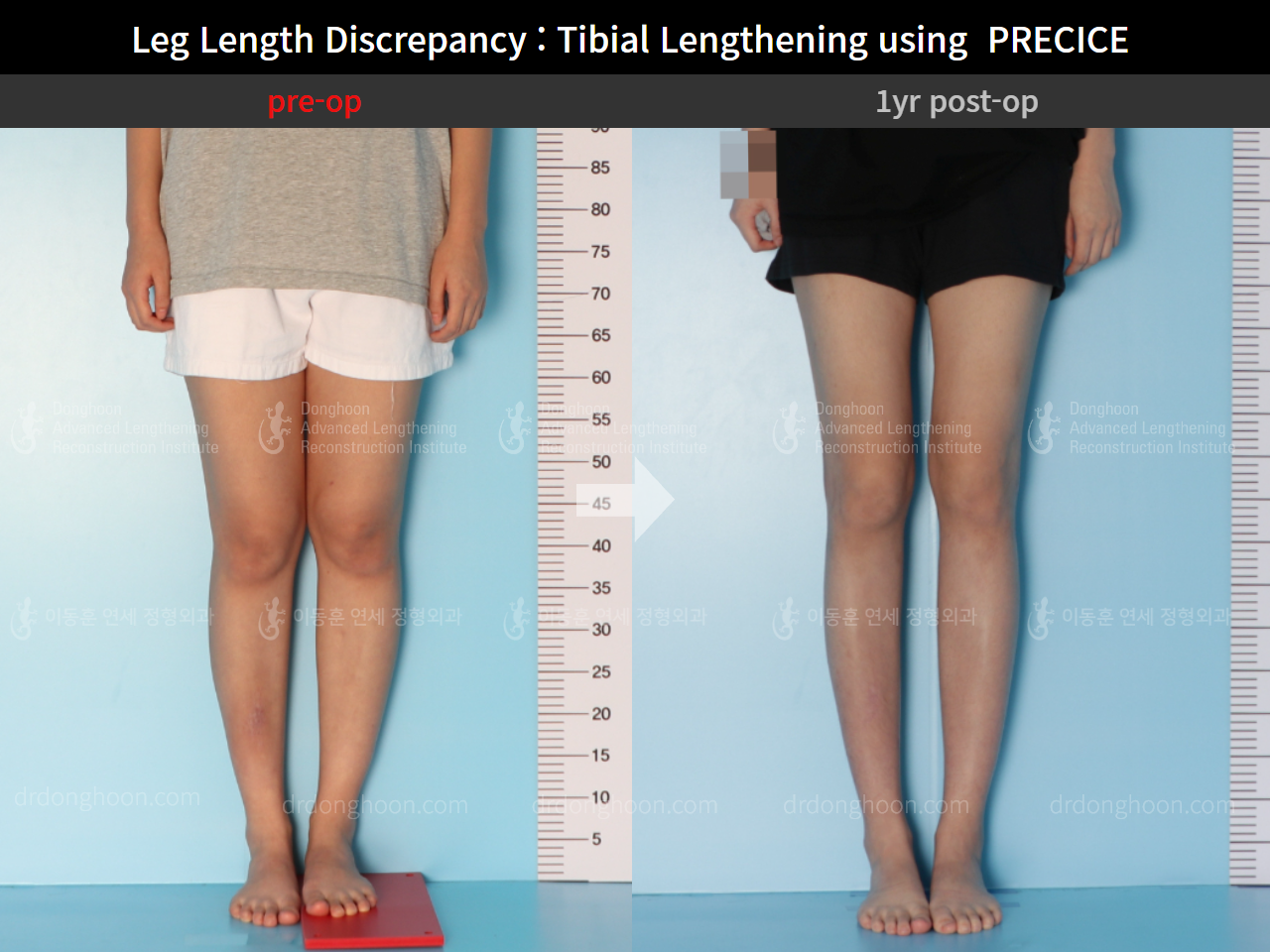 Before and after adult lld, case 8910234, image 3, Dr. Donghoon institute (DALRI)