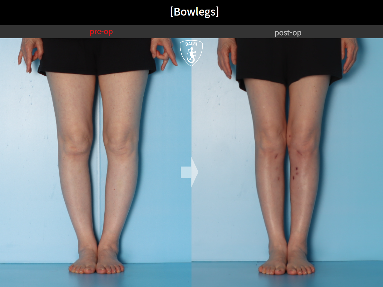 Before and after adult bowlegs, case 30256399, image 8, Dr. Donghoon institute (DALRI)