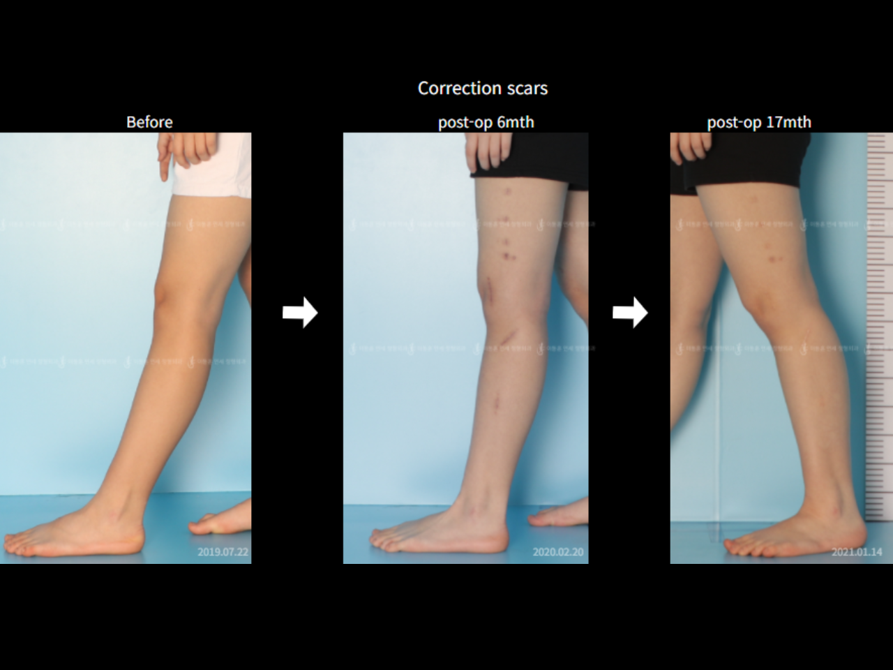 Before and after complex deformity, case 6883057, image 6, Dr. Donghoon institute (DALRI)