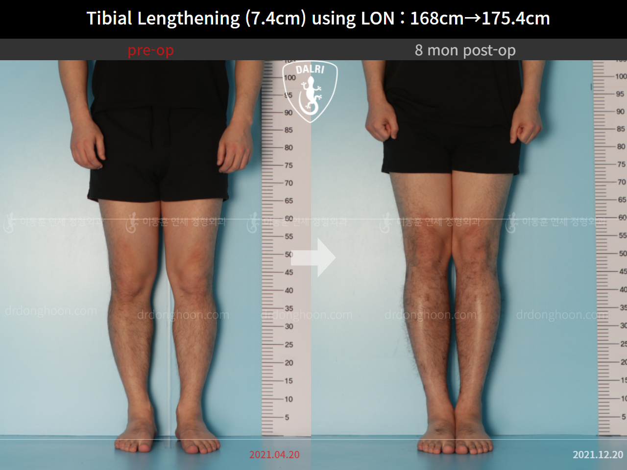 Before and after cll lon, case 9188051, image 5, Dr. Donghoon institute (DALRI)