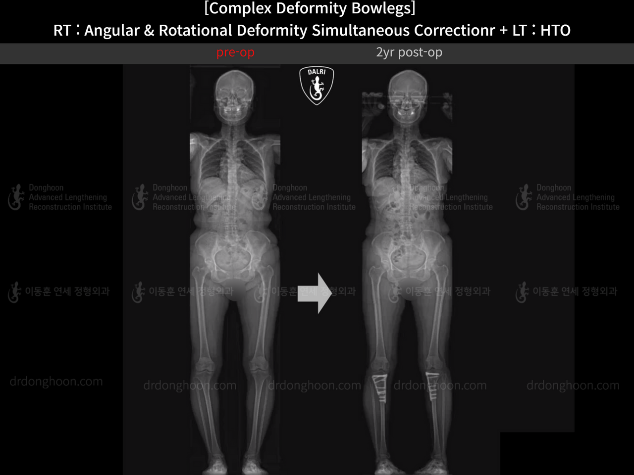 Before and after adult bowlegs, case 14328178, image 7, Dr. Donghoon institute (DALRI)