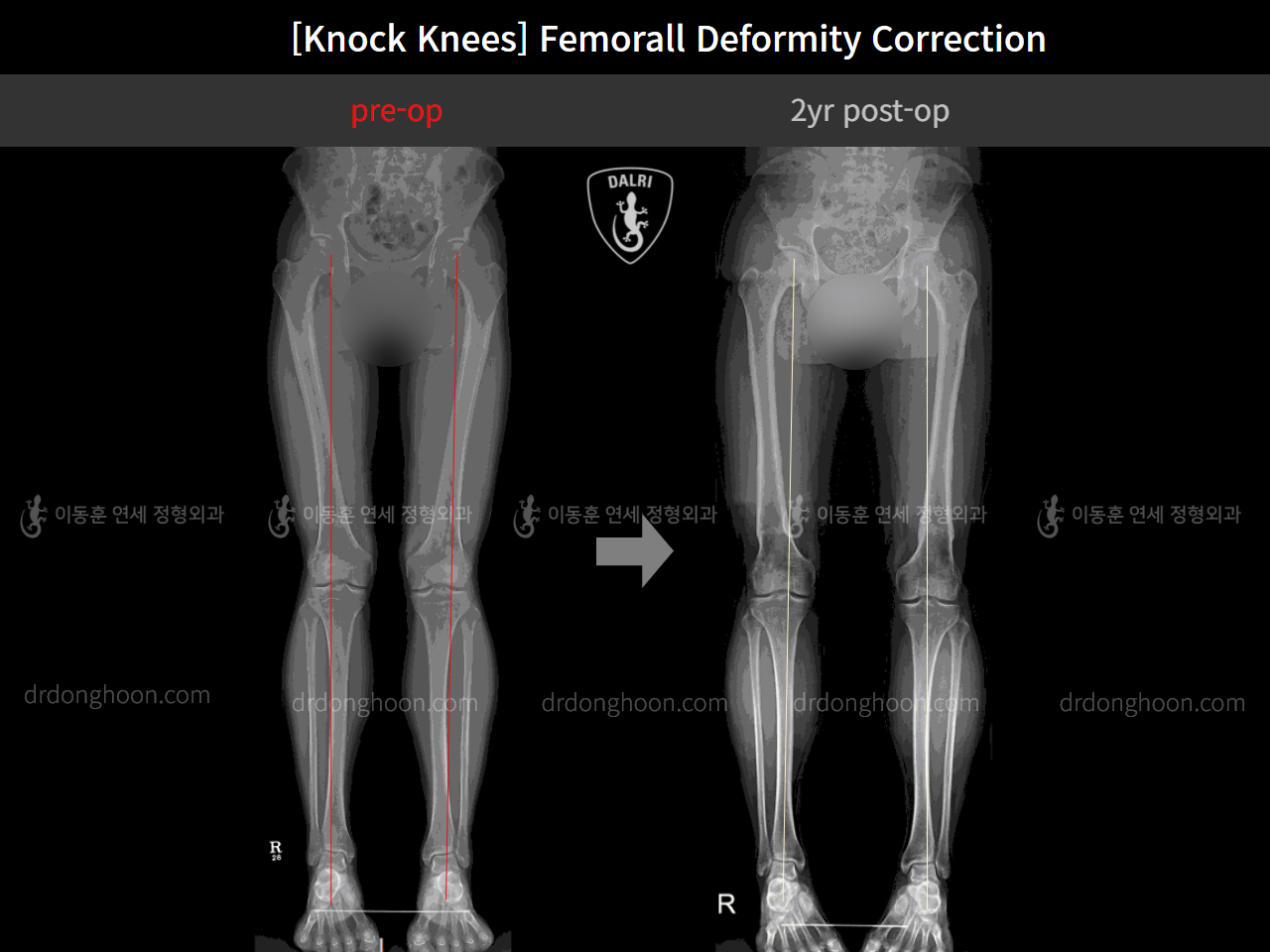 Before and after adult knock knees, case 4310847, image 7, Dr. Donghoon institute (DALRI)