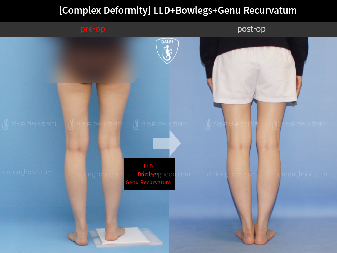 Before and after complex deformity, case 11648309, image 6, Dr. Donghoon institute (DALRI)