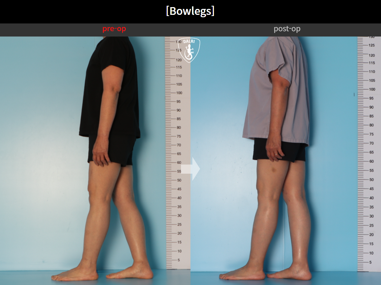 Before and after adult bowlegs, case 30770070, image 7, Dr. Donghoon institute (DALRI)