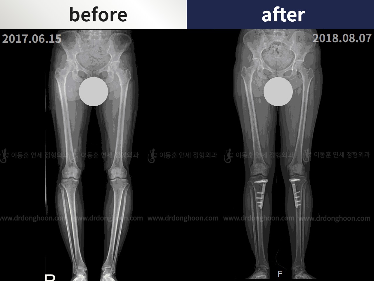 Before and after adult bowlegs, case 4311011, image 3, Dr. Donghoon institute (DALRI)
