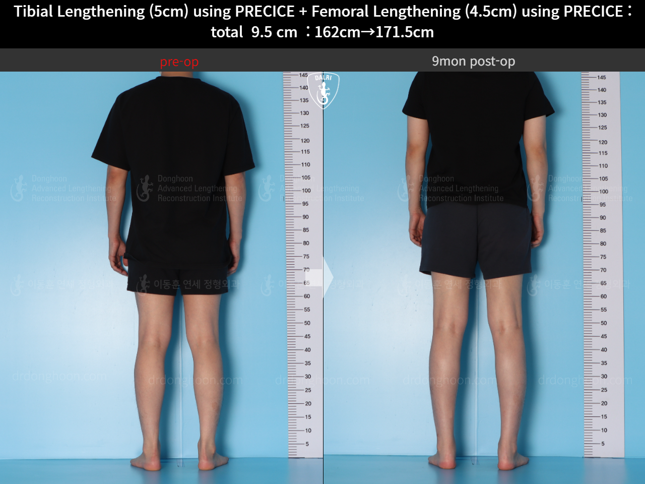 Before and after cll precice, case 15344460, image 4, Dr. Donghoon institute (DALRI)