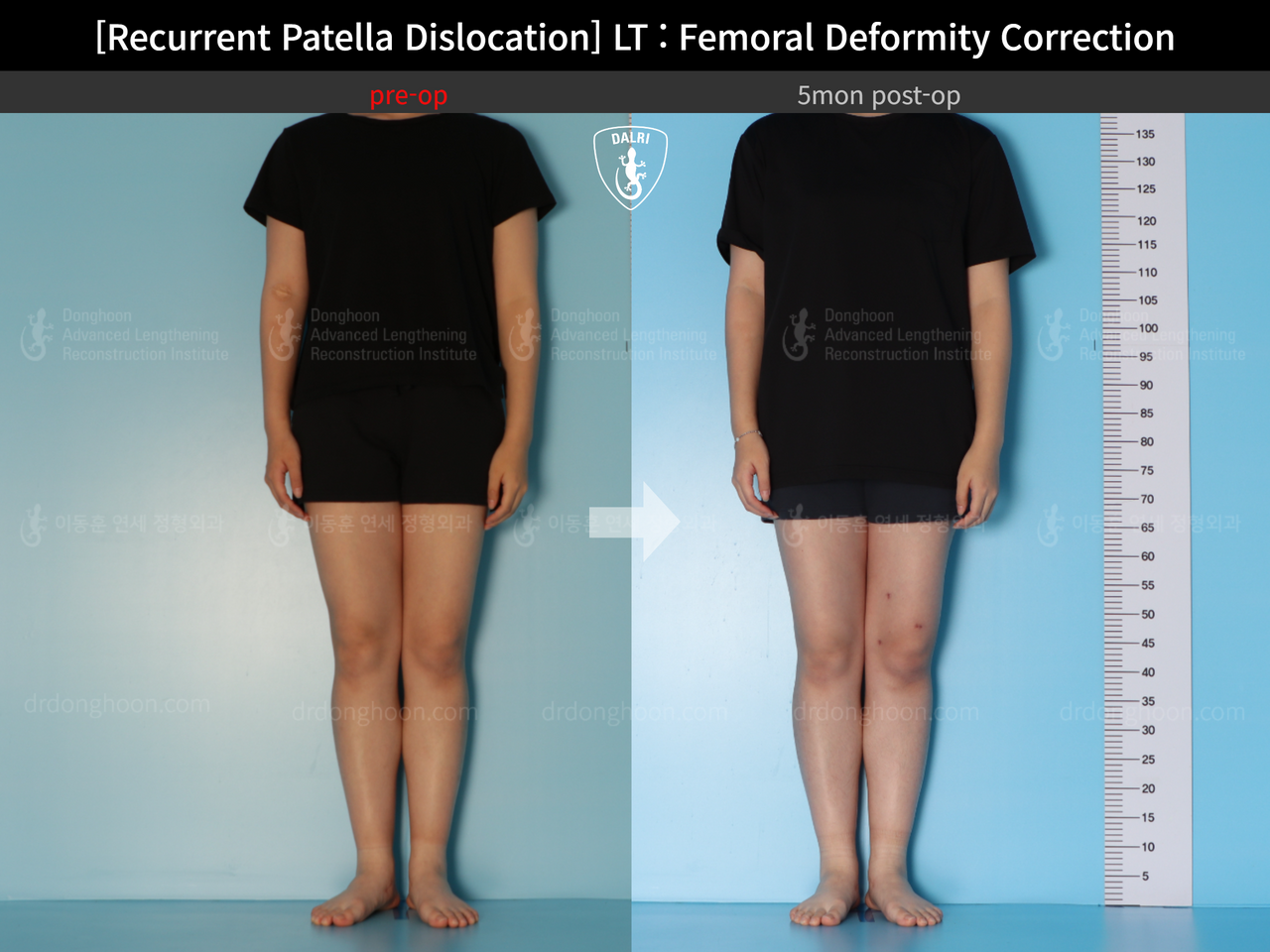 Before and after recurrent patella dislocation, case 13337596, image 3, Dr. Donghoon institute (DALRI)