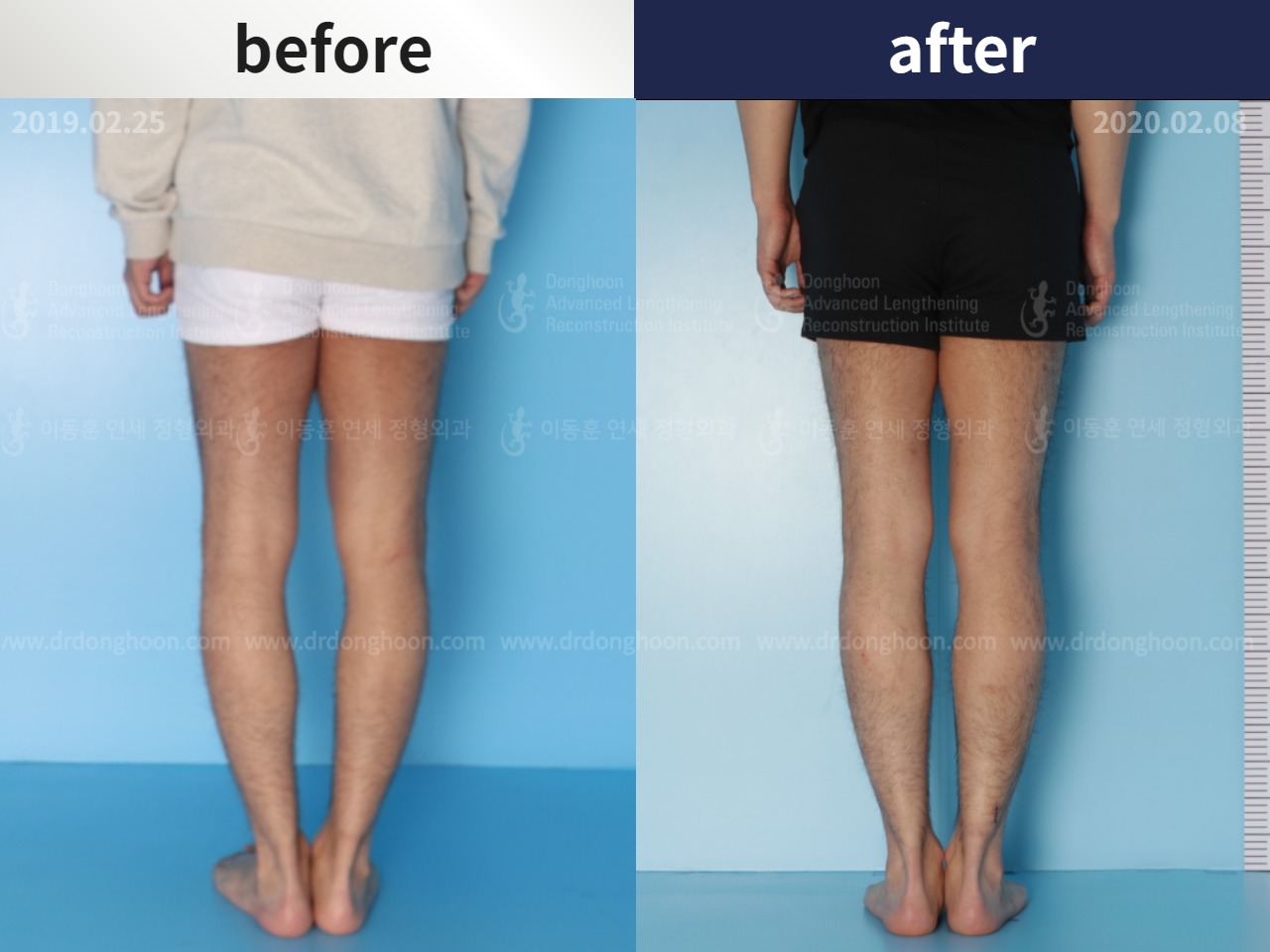 Before and after adult bowlegs, case 4586220, image 2, Dr. Donghoon institute (DALRI)