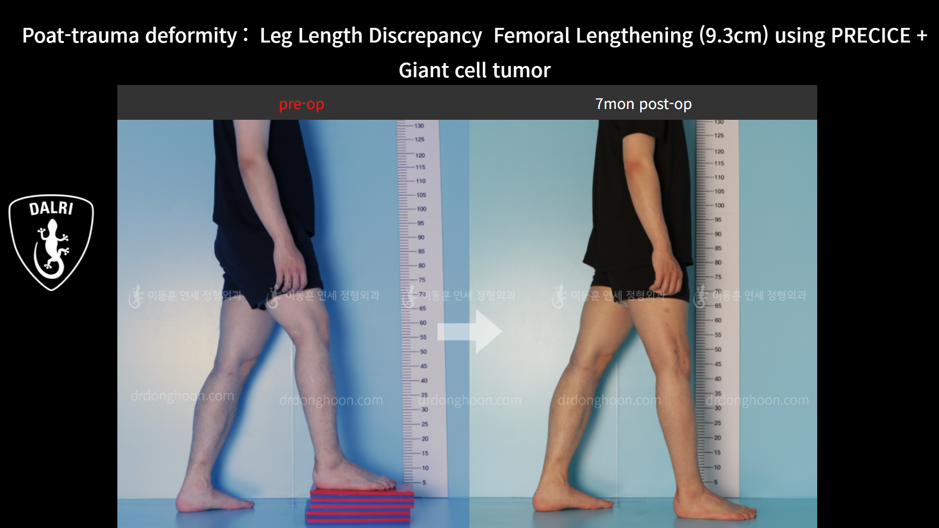 Before and after post-trauma deformity, case 8606746, image 4, Dr. Donghoon institute (DALRI)