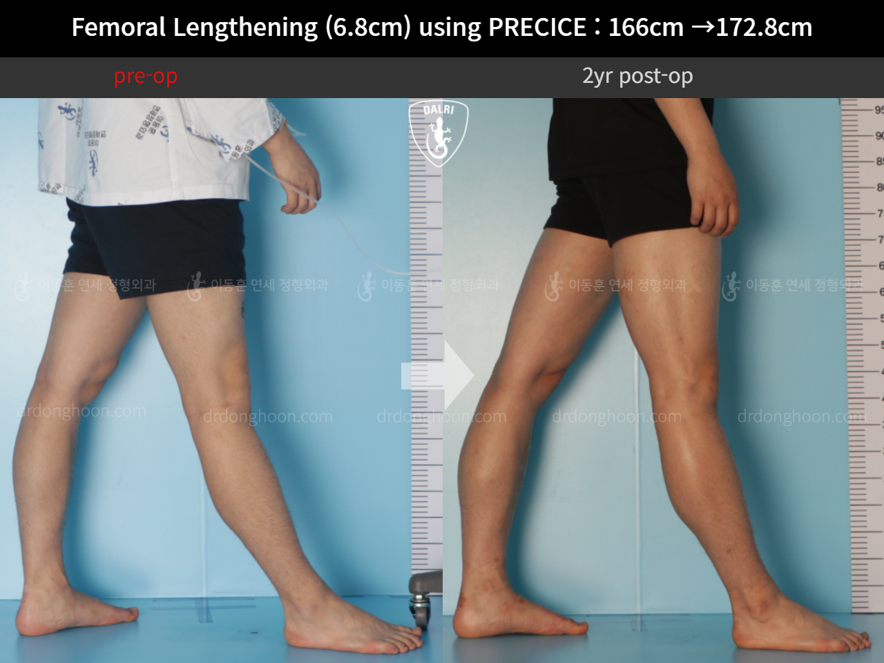Before and after cll precice, case 10883099, image 8, Dr. Donghoon institute (DALRI)