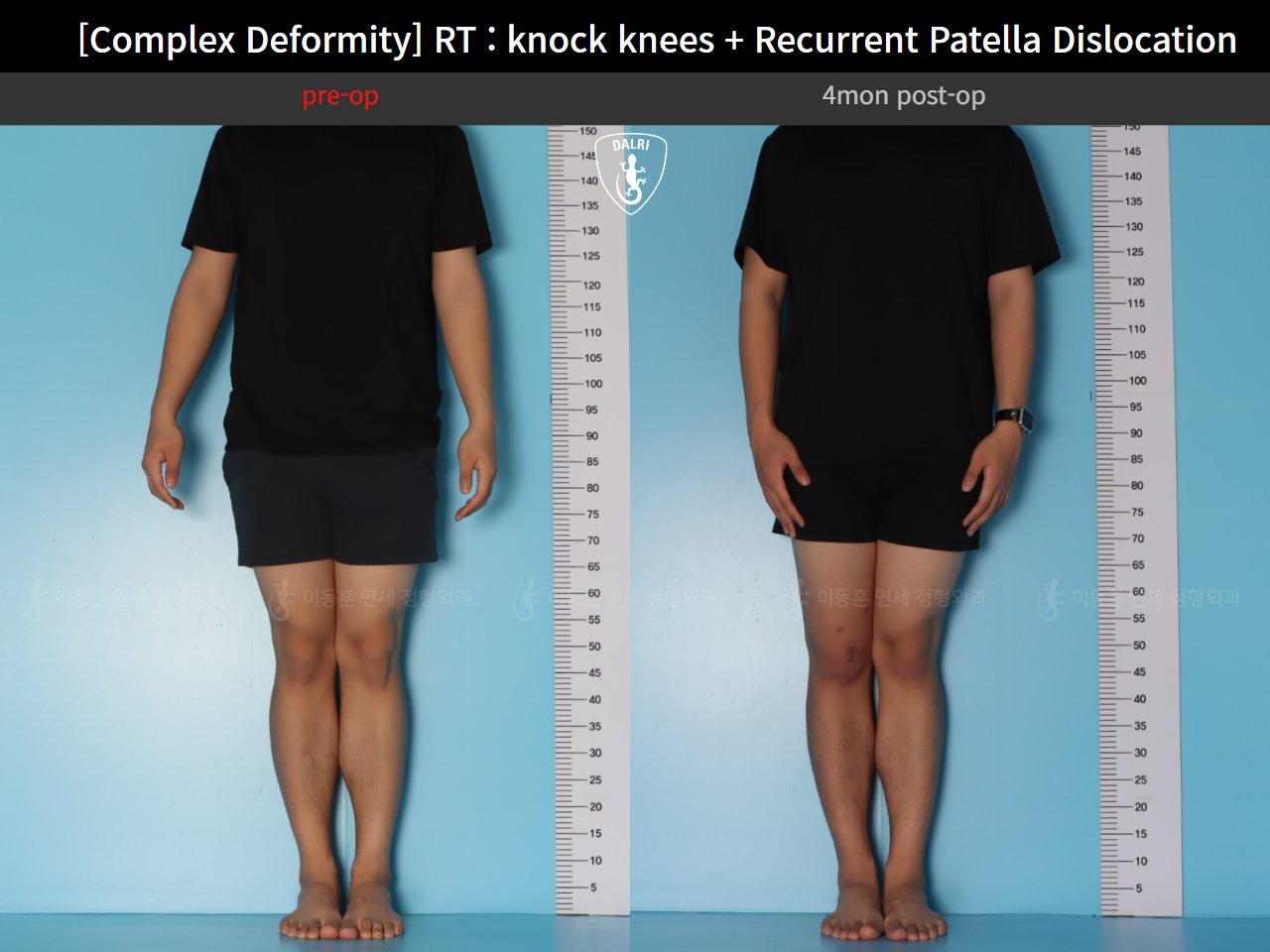 Before and after complex deformity, case 125841720, image 3, Dr. Donghoon institute (DALRI)
