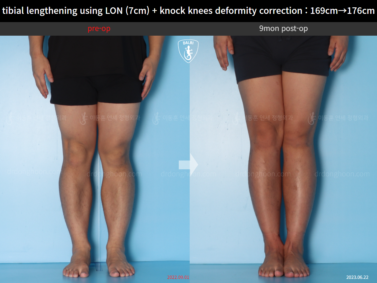 Before and after cll + deformity correction, case 15748291, image 4, Dr. Donghoon institute (DALRI)