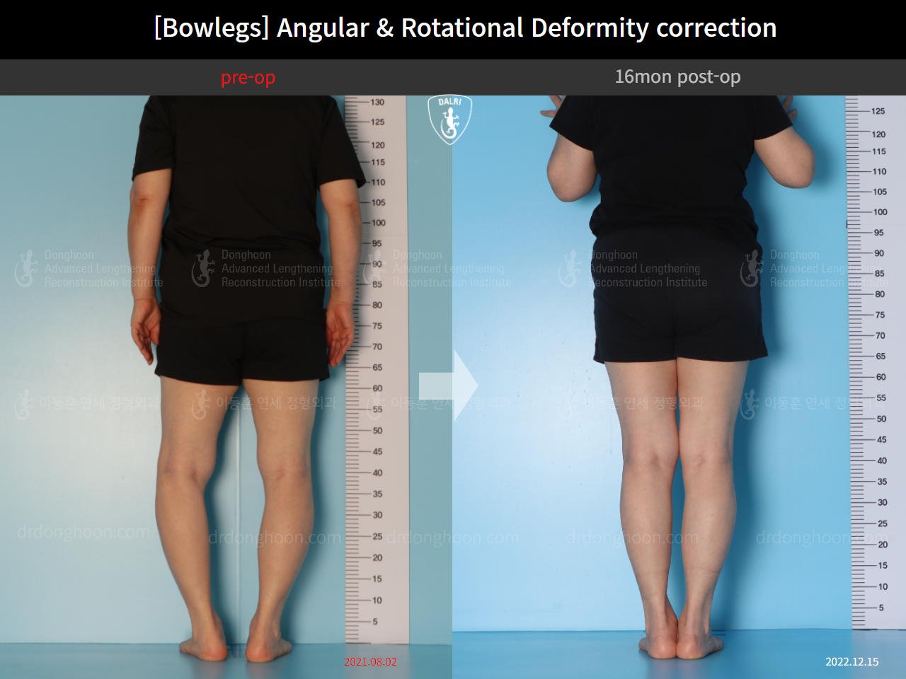 Before and after adult bowlegs, case 14637299, image 2, Dr. Donghoon institute (DALRI)