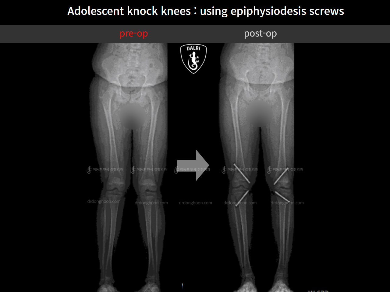 Before and after paediatric & adolescent knock knees, case 4310914, image 6, Dr. Donghoon institute (DALRI)