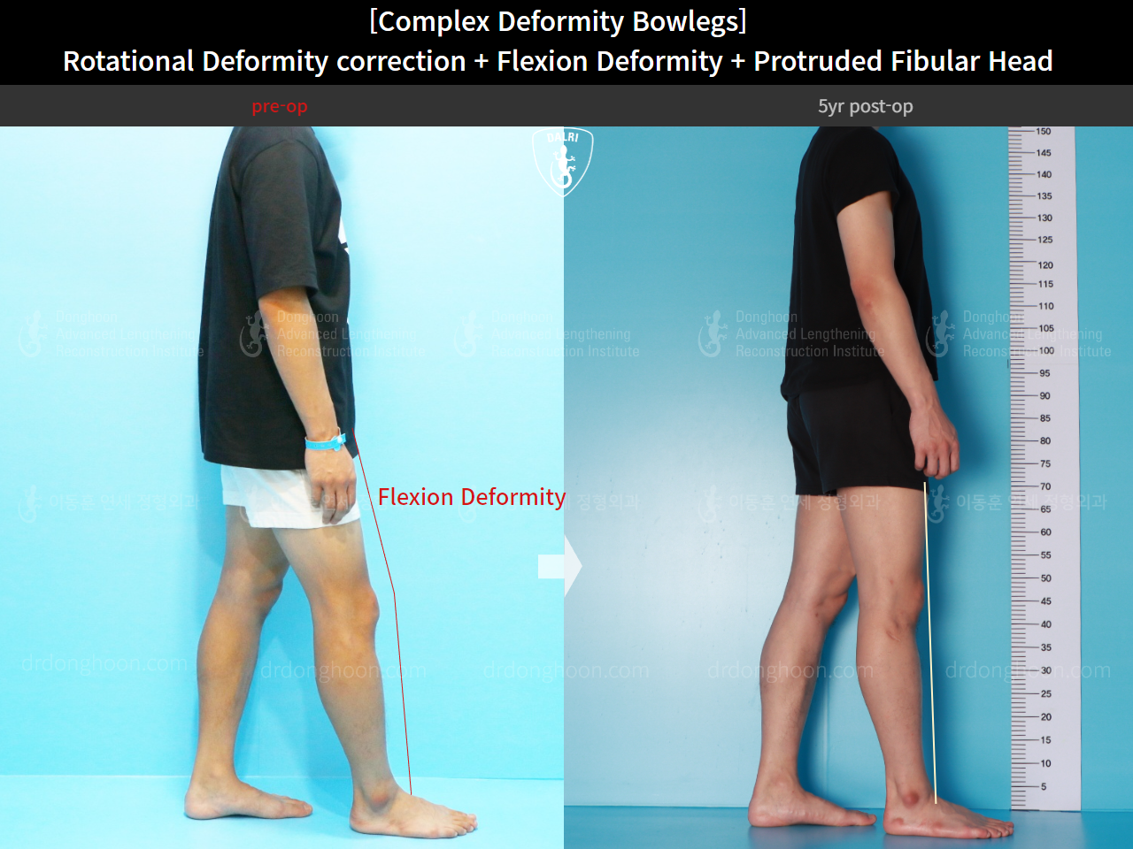 Before and after complex deformity, case 15944755, image 5, Dr. Donghoon institute (DALRI)