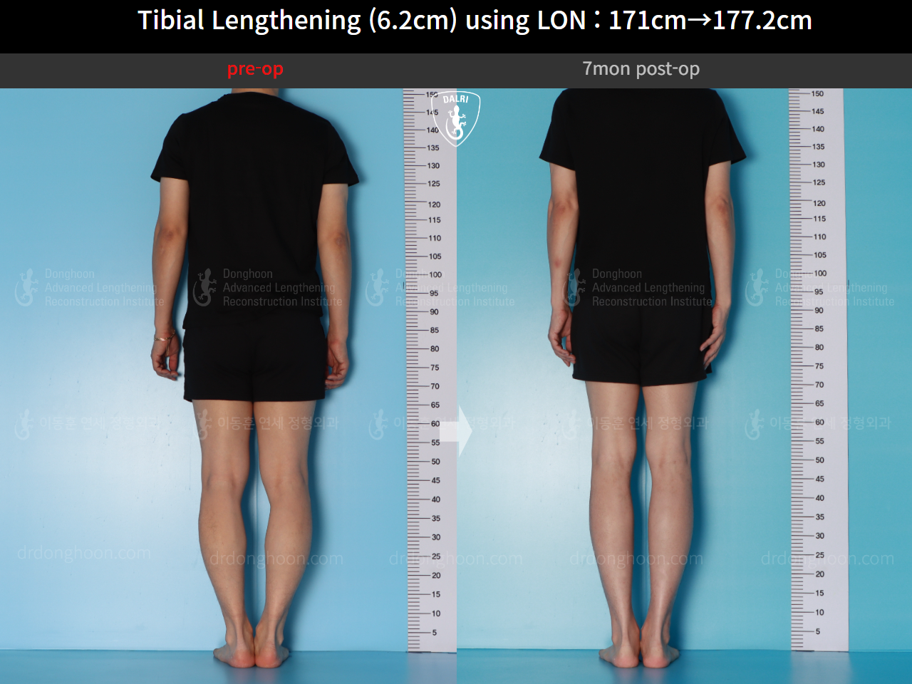Before and after cll lon, case 16713373, image 3, Dr. Donghoon institute (DALRI)