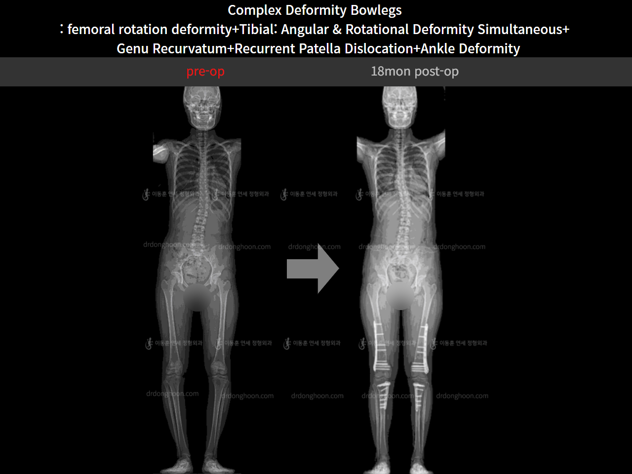 Before and after complex deformity, case 11244013, image 6, Dr. Donghoon institute (DALRI)