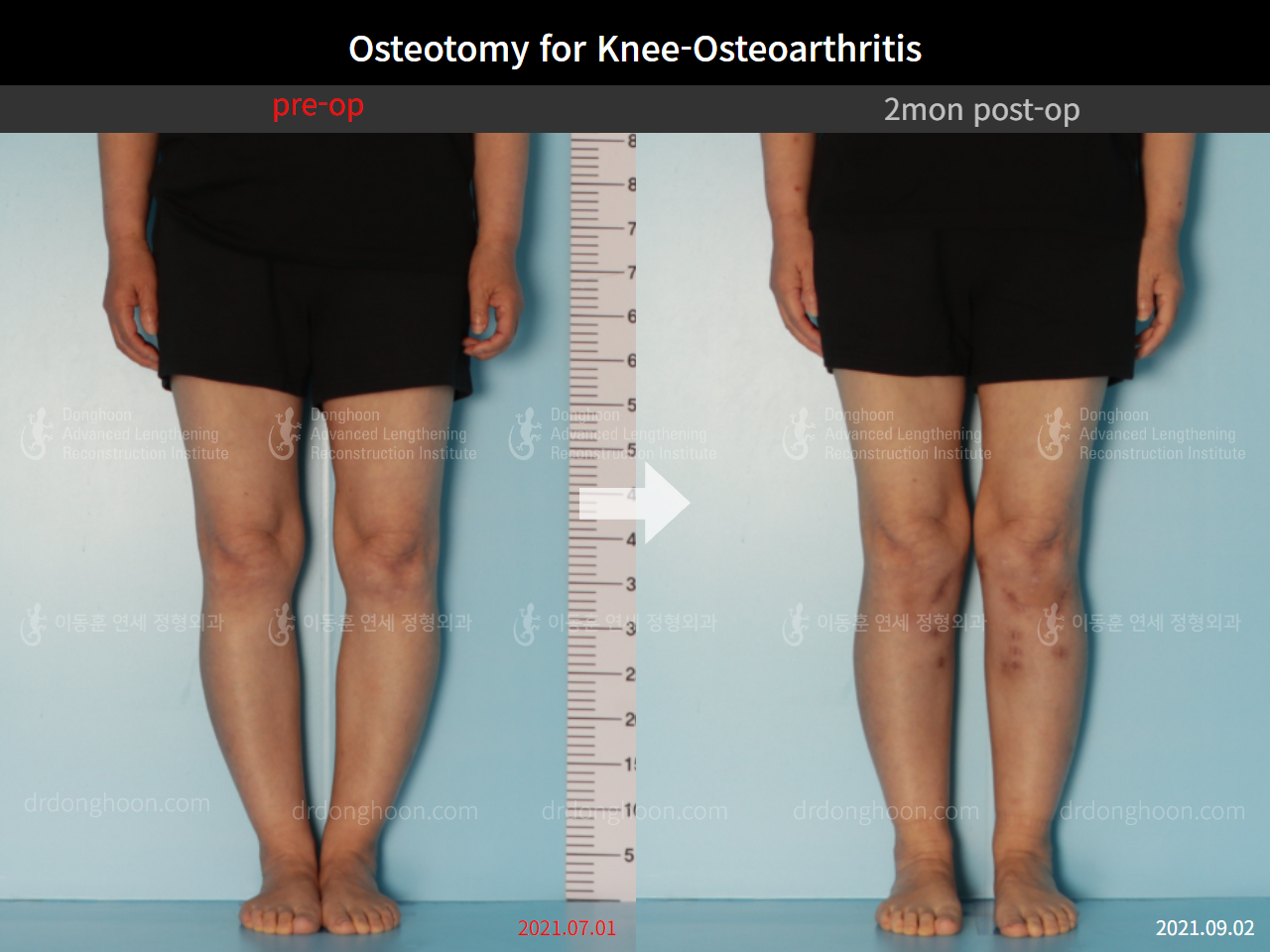 Before and after osteotomy for knee osteoarthritis, case 8826307, image 3, Dr. Donghoon institute (DALRI)