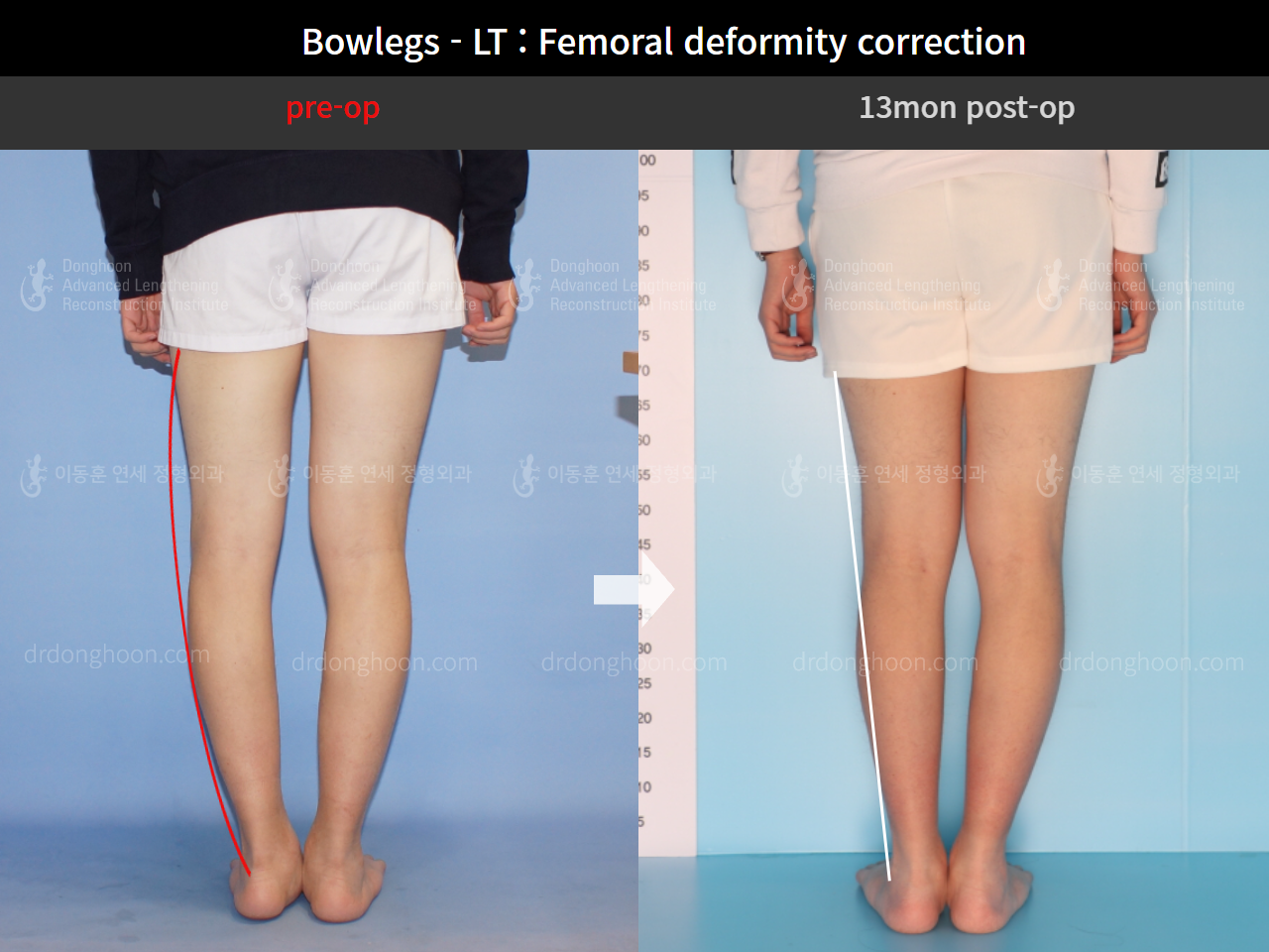 Before and after adult bowlegs, case 8932864, image 4, Dr. Donghoon institute (DALRI)