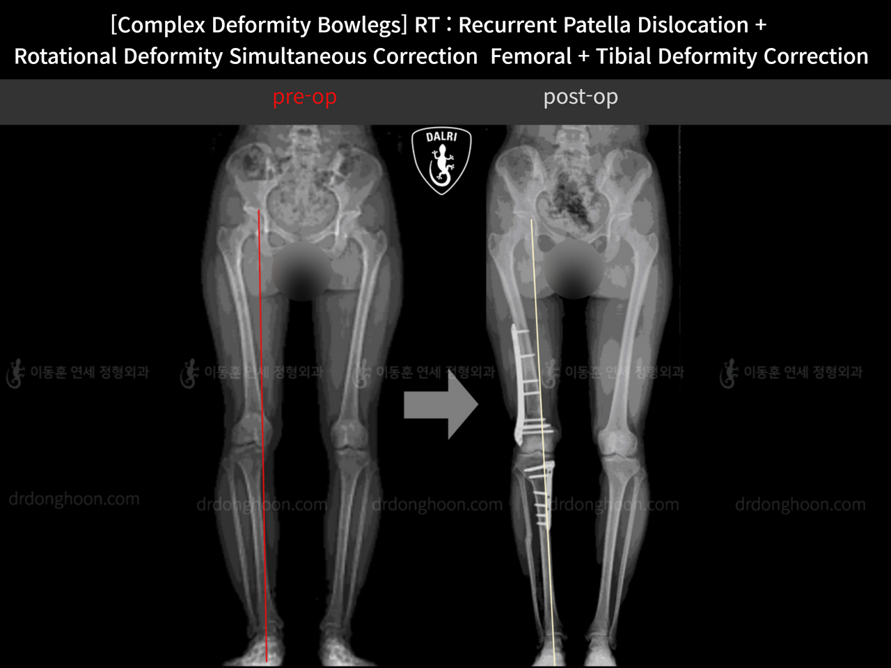 Before and after adult bowlegs, case 12255252, image 6, Dr. Donghoon institute (DALRI)
