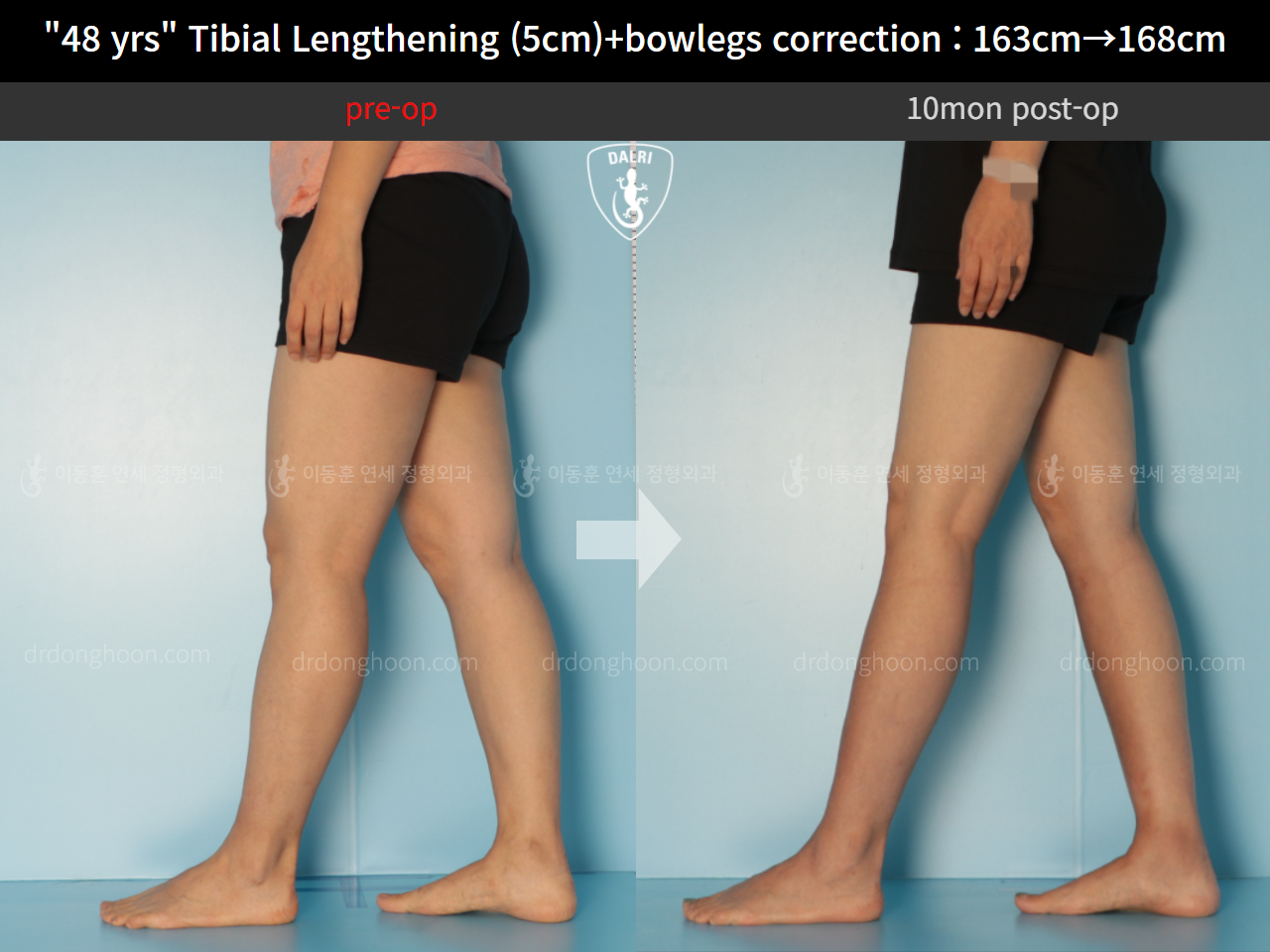 Before and after cll precice, case 10474341, image 8, Dr. Donghoon institute (DALRI)