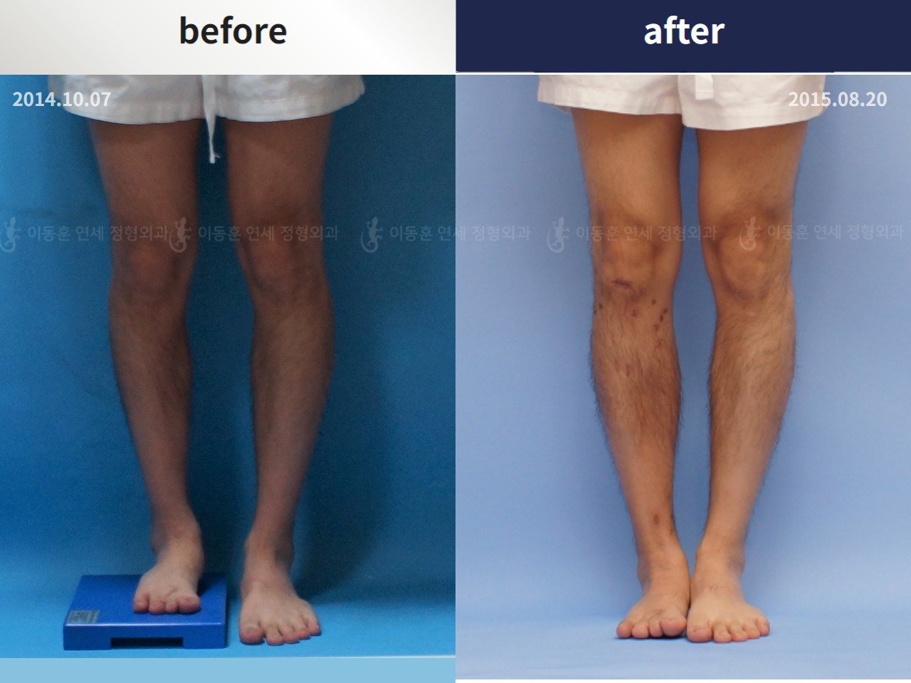 Before and after adult lld, case 4320316, image 4, Dr. Donghoon institute (DALRI)